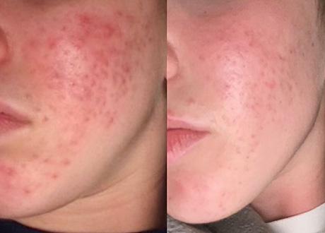 close up of before and after of a women's skin after treatmentIntroducing our Clarity Facial — a 60-minute treatment powered by Environ’s medical-grade Clarity skincare. Designed for acne-prone and reactive skin, this gentle yet targeted facial helps calm